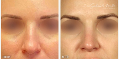 Rhinoplasty before and after photo