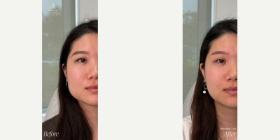 Botox for TMJ before and after photo