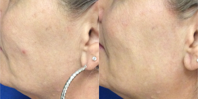 Chemical Peel before and after photo