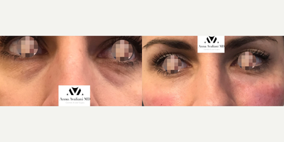 Dermal Fillers before and after photo