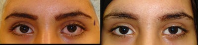 Eyelid Retraction Repair before and after photo