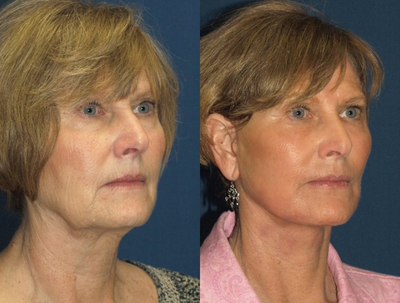 Facelift before and after photo