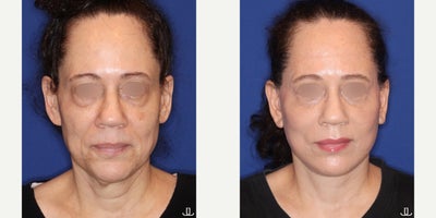Facelift before and after photo