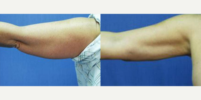 Liposuction before and after photo