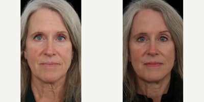 before and after image
