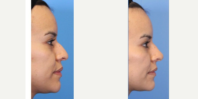 Nonsurgical Nose Job before and after photo