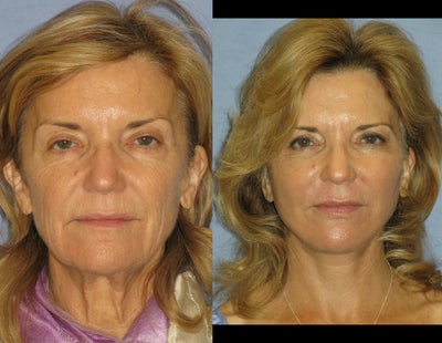 QuickLift before and after photo