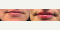 Restylane before and after photo