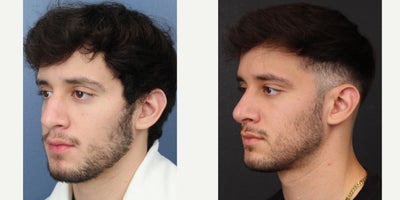 Rhinoplasty before and after photo