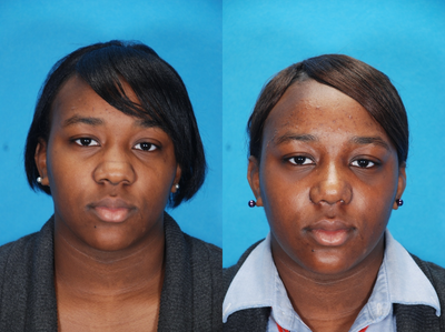 African American Rhinoplasty before and after photo
