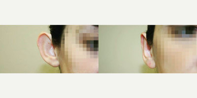 Ear Surgery before and after photo