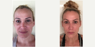 Microneedling before and after photo