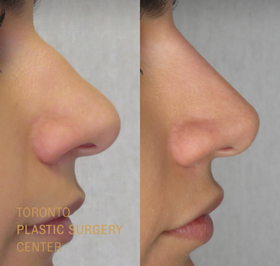 Nonsurgical Nose Job before and after photo