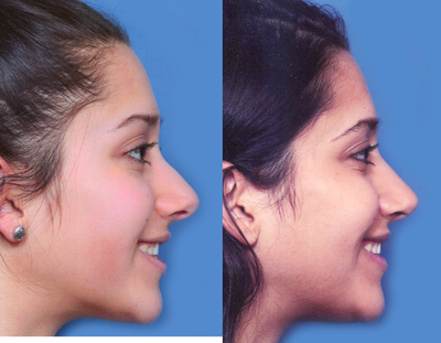 Rhinoplasty before and after photo