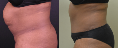 Tummy Tuck before and after photo
