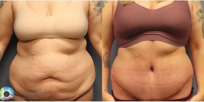 Tummy Tuck before and after photo