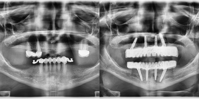 All-on-4 Dental Implants before and after photo