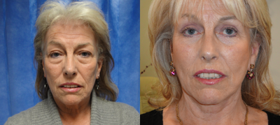 Facelift before and after photo
