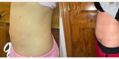 Morpheus8 before and after photo
