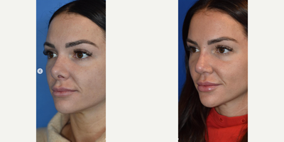 Revision Rhinoplasty before and after photo