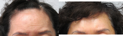 Brow Lift before and after photo