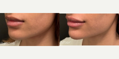Dermal Fillers before and after photo