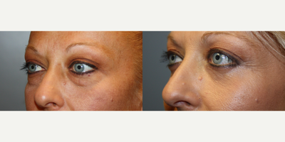 Eyelid Surgery before and after photo