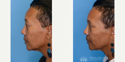Eyelid Surgery before and after photo