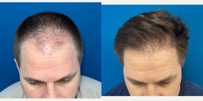 Hair Transplant before and after photo