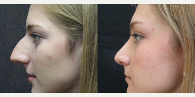 Rhinoplasty before and after photo