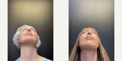 Rhinoplasty before and after photo