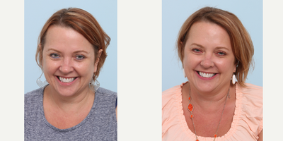 Botox before and after photo