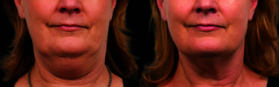 CoolSculpting before and after photo