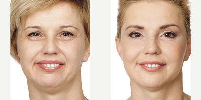 Dermal Fillers before and after photo