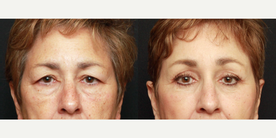 Eyelid Surgery before and after photo
