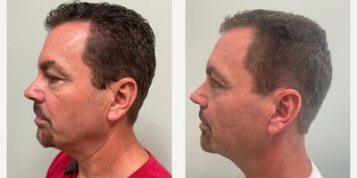 Eyelid Surgery before and after photo