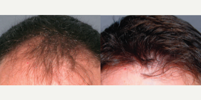 Hair Loss Treatment before and after photo