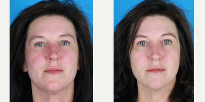 Laser Resurfacing before and after photo