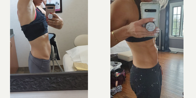 Emsculpt before and after photo
