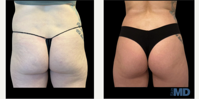 Emsculpt before and after photo