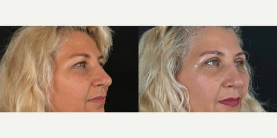 Eyelid Surgery before and after photo