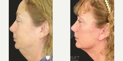 Facelift before and after photo