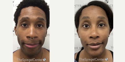 Facial Feminization Surgery before and after photo