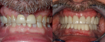 Full Mouth Reconstruction before and after photo