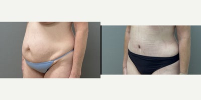 Tummy Tuck before and after photo