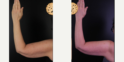 CoolSculpting before and after photo