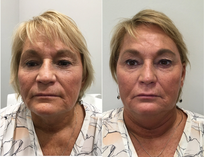 Dysport before and after photo