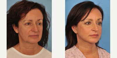 Facelift before and after photo