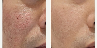 Fractional Laser before and after photo