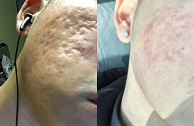 Fraxel Laser before and after photo